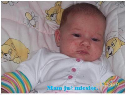 Moja śliczna buźka cała w krostkach :(